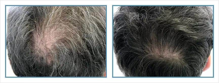 Before and after men's hair transplant - NM3v - 1,200 FUs - Crown