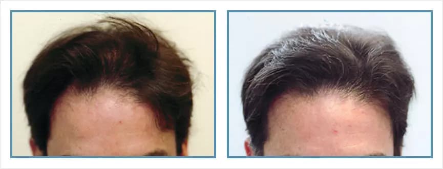 Before and after men's hair transplant - NM3v - 2,100 FUs - Frontal / Crown
