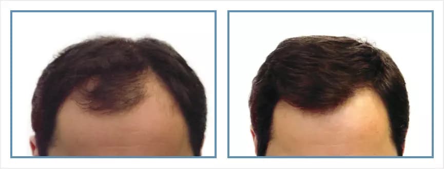 Before and after men's hair transplant - NM4 - 3,200 FUs - Frontal / Crown