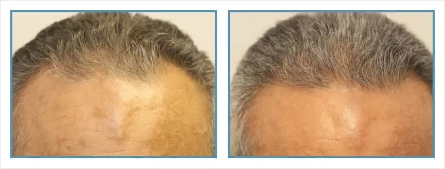 Before and after men's hair transplant - NW1 - 1375 FUs - Hairline