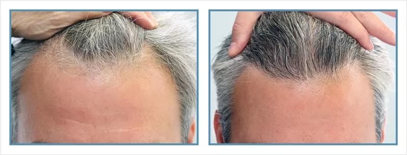 Before and after men's hair transplant - NW1 - 800 FUs - Hairline