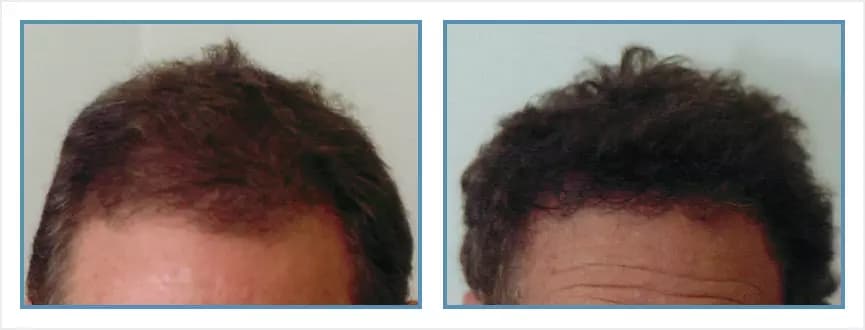Before and after men's hair transplant - NW1 - 850 FUs - Hairline
