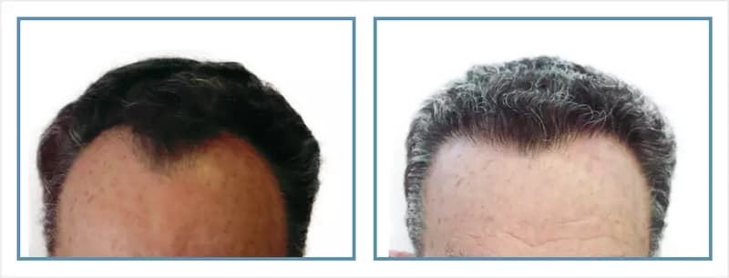 Before and after men's hair transplant - NW2 - 1,425 FUs - Hairline / Frontal