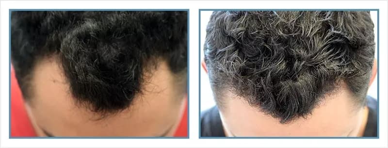 Before and after men's hair transplant - NW2 - 775 FUs - Hairline / Frontal