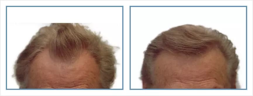 Before and after men's hair transplant - NW2a - 1,600 FUs - Hairline / Frontal
