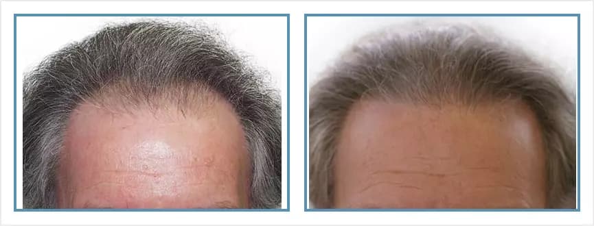 Before and after men's hair transplant - NW3 - 1,500 FUs - Hairline / Frontal