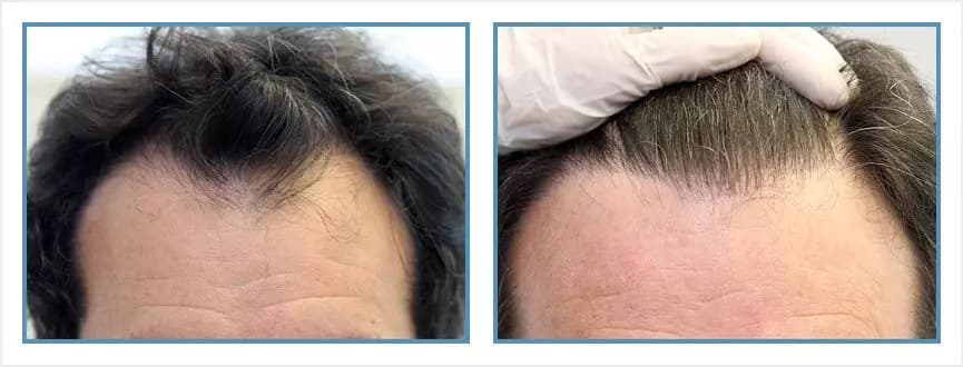 Before and after men's hair transplant - NW3 - 3,275 FUs - Hairline / Frontal