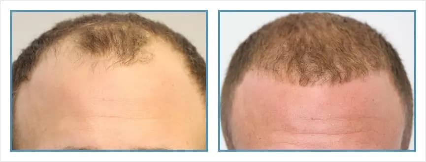 Before and after men's hair transplant - NW3a - 2,900 FUs - Hairline / Frontal