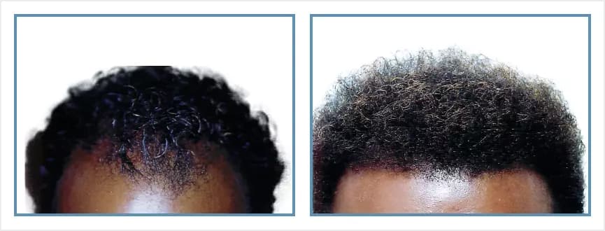 Before and after men's hair transplant - NW3a - 850 FUs - Frontal / Scalp