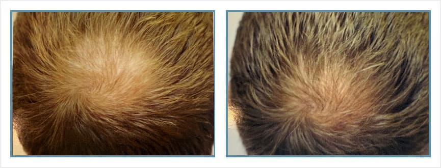 Before and after men's hair transplant - NW3v- 1,400 FUs - Frontal / Crown
