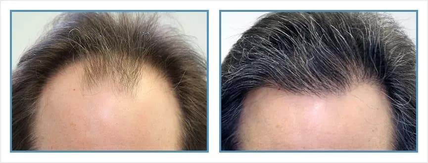 Before and after men's hair transplant - NW4a - 2,000 FUs - Hairline / Crown