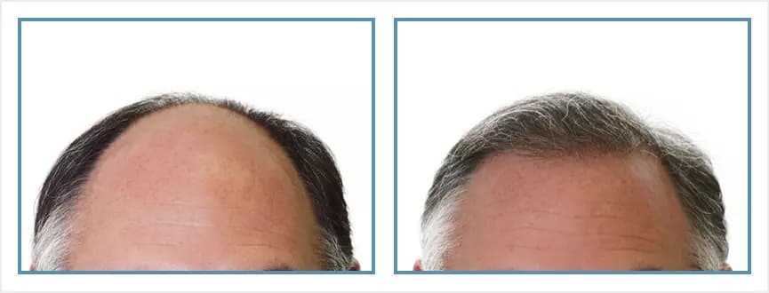 Before and after men's hair transplant - NW4a - 5,000 FUs - Hairline / Density