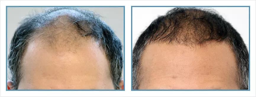 Before and after men's hair transplant - NW5 - 1,390 FUs - Hairline / Density