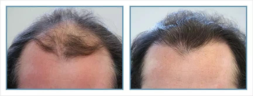 Before and after men's hair transplant - NW5 - 1,750 FUs - Hairline / Density