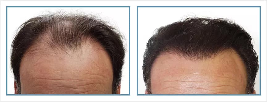 Before and after men's hair transplant - NW5 - 2,400 FUs - Hairline / Crown