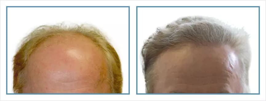 Before and after men's hair transplant - NW5a - 1,925 FUs - Hairline / Crown