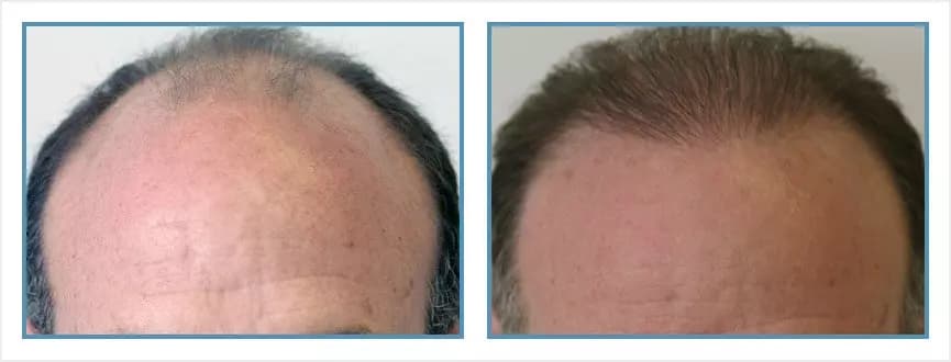 Before and after men's hair transplant - NW5a - 1,950 FUs - Hairline / Crown