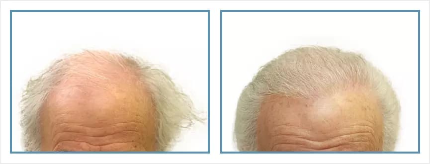 Before and after men's hair transplant - NW5a - 2,450 FUs - Hairline / Crown