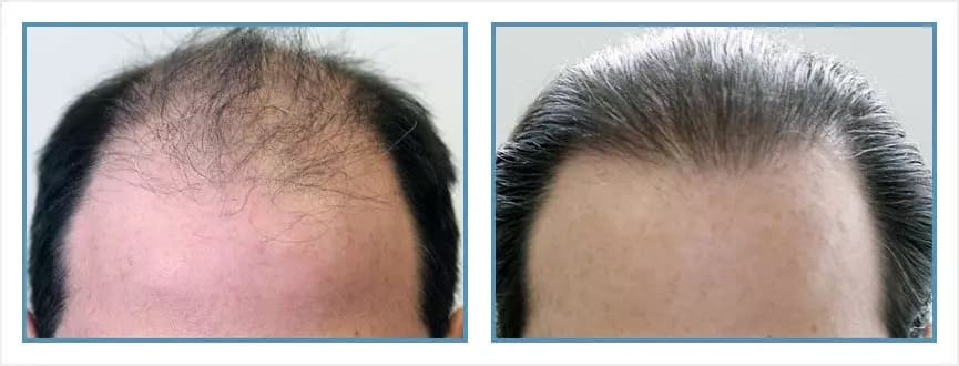 Before and after men's hair transplant - NW5a - 3,300 FUs - Hairline / Crown