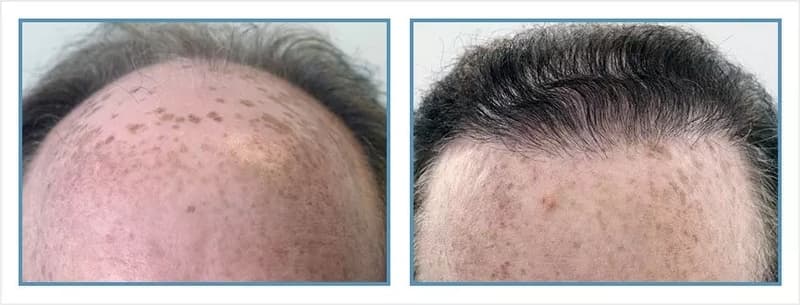Before and after men's hair transplant - NW5a - 3,475 FUs - Hairline / Crown