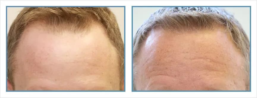 Before and after men's hair transplant - NW5a- 1,475 FUs - Hairline / Crown