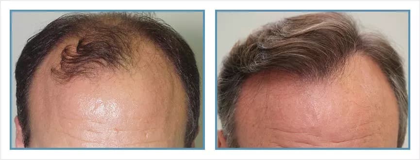 Before and after men's hair transplant - NW5v - 5,025 FUs - Overall Coverage