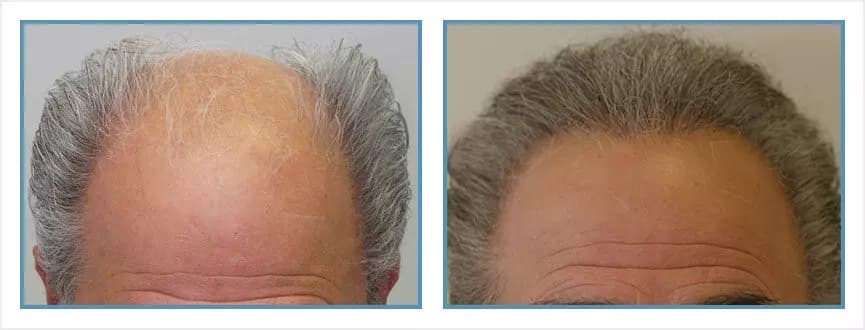 Before and after men's hair transplant - NW6 - 1,425 FUs - Hairline / Crown