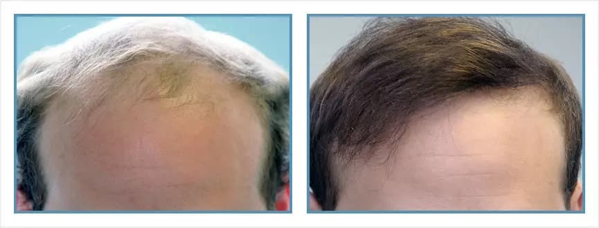 Before and after men's hair transplant - NW6 - 2,900 FUs - Hairline / Crown