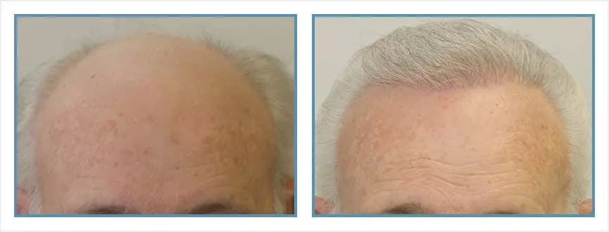 Before and after men's hair transplant - NW6 - 3,200 FUs - Hairline / Crown
