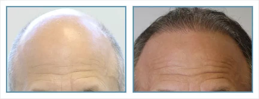 Before and after men's hair transplant - NW7 - 1,143 FUs - Hairline / Frontal