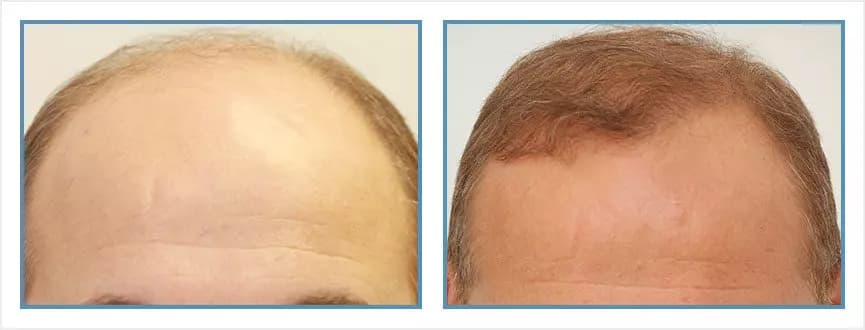 Before and after men's hair transplant - NW7 - 3,825 FUs - Hairline / Post-Frontal