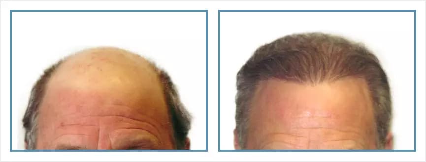 Before and after men's hair transplant - NW7 - 4,525 FUs - Hairline / Post-Frontal