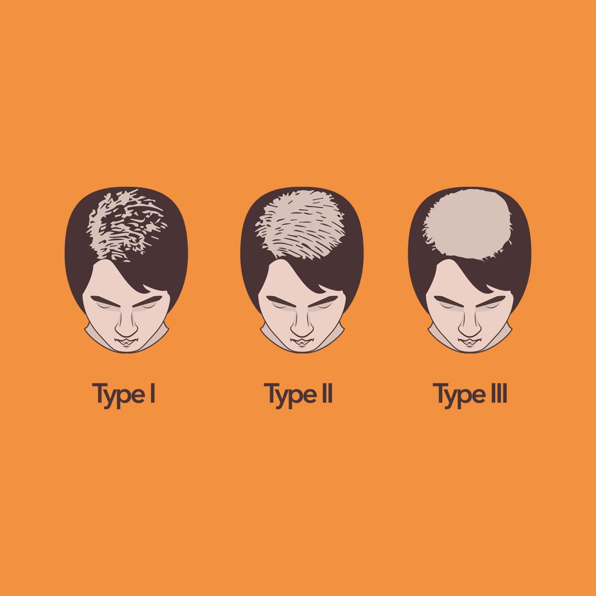 Womens Norwood Scale