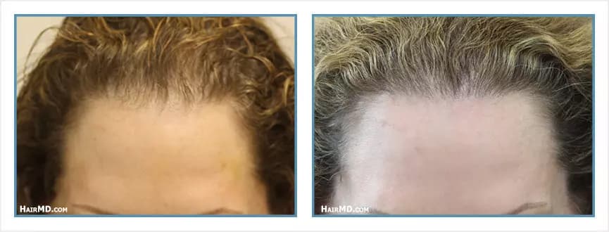 Before and after women's hair transplant - LW Frontal - 1,500 FUs - Hairline