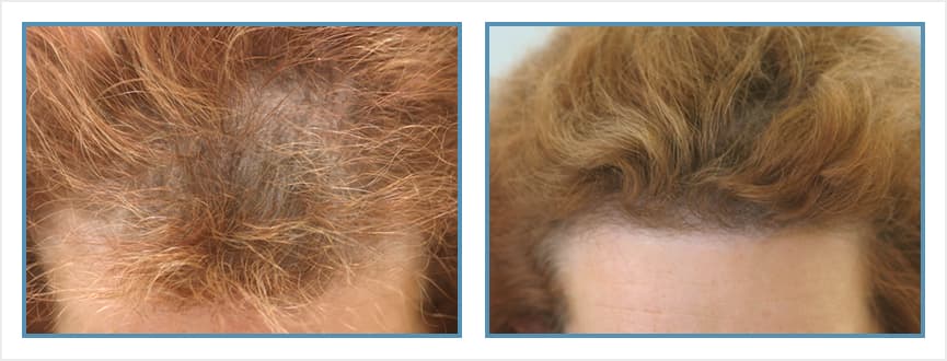 Before and after women's hair transplant - LW Frontal - 1,725 FUs - Hairline