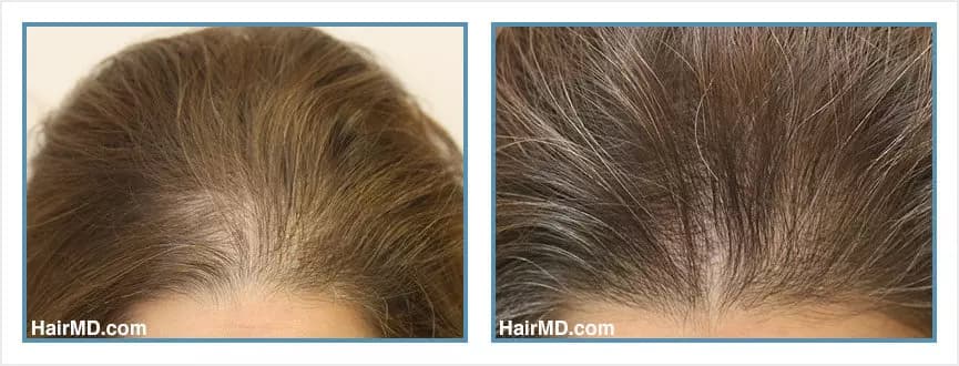 Before and after women's hair transplant - LW1 - 925 FUs - Frontal Area