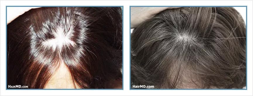 Before and after women's hair transplant - LW1 - 990 FUs - Frontal Area