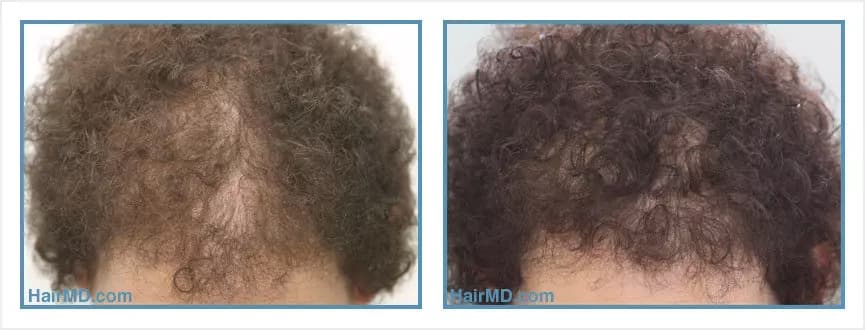 Before and after women's hair transplant - LW2 - 1,000 FUs - Frontal Area