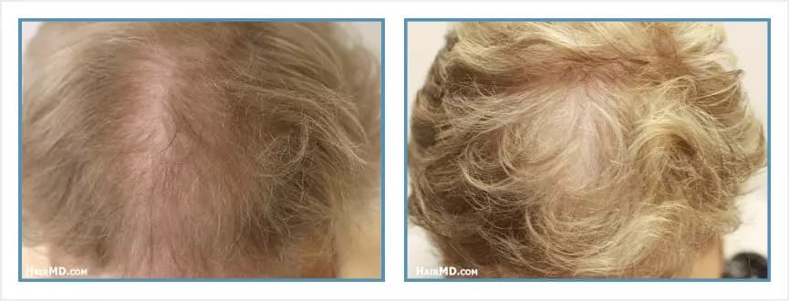 Before and after women's hair transplant - LW2 - 1,250 FUs - Frontal Area