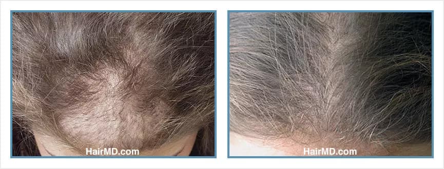 Before and after women's hair transplant - LW2 - 800 FUs - Frontal Area