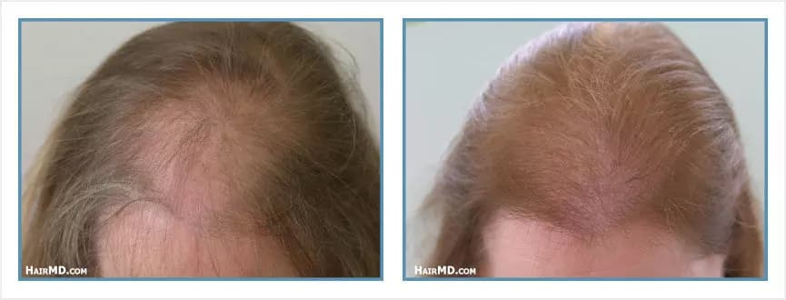 Before and after women's hair transplant - LW3 - 1,380 FUs - Frontal Area