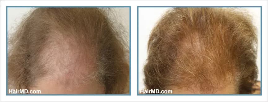 Before and after women's hair transplant - LW3 - 825 FUs - Frontal Area