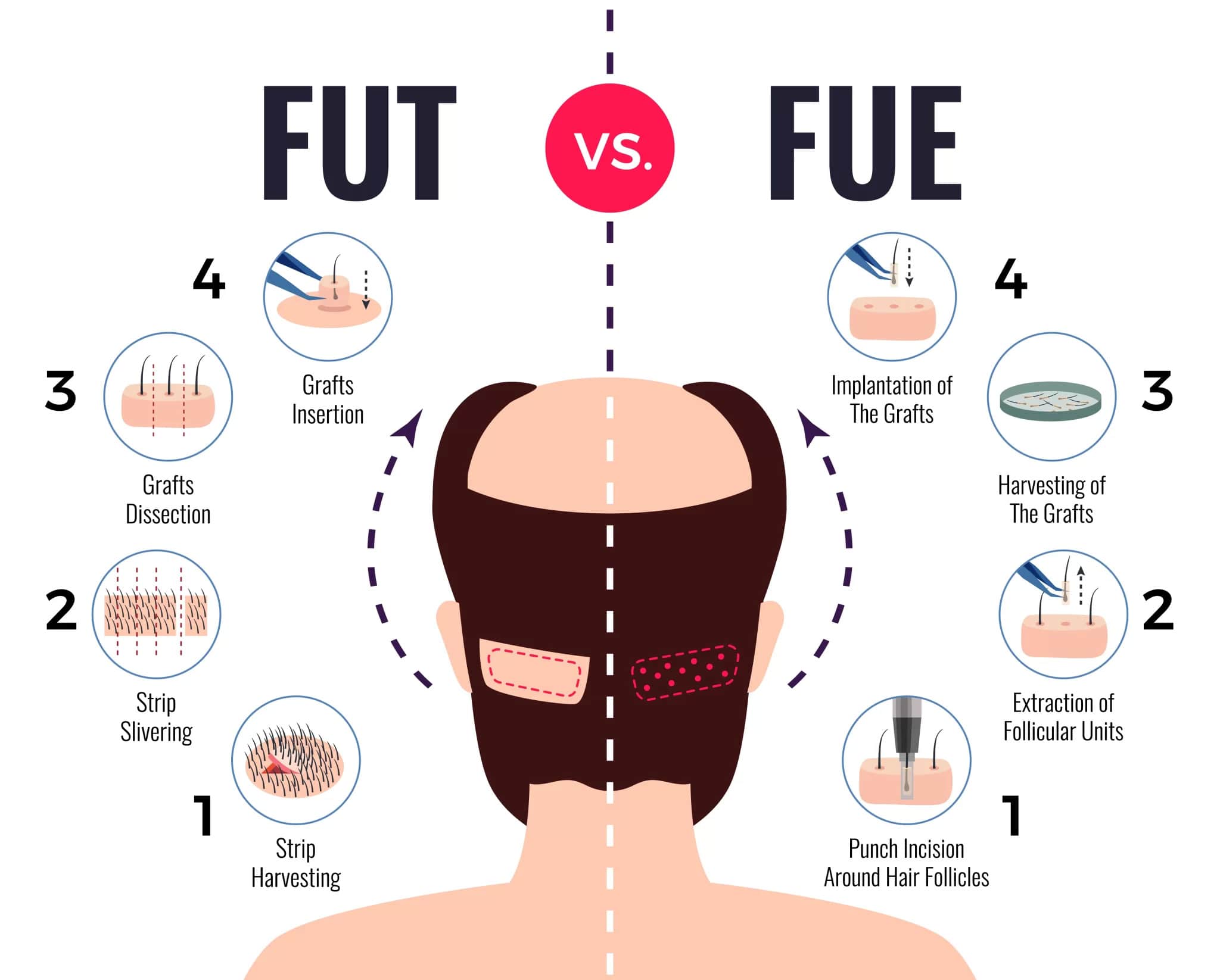 Illustration of FUT hair transplant strip method steps