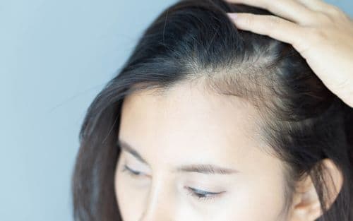 Answering The Most Frequently Asked Questions on Hair Loss