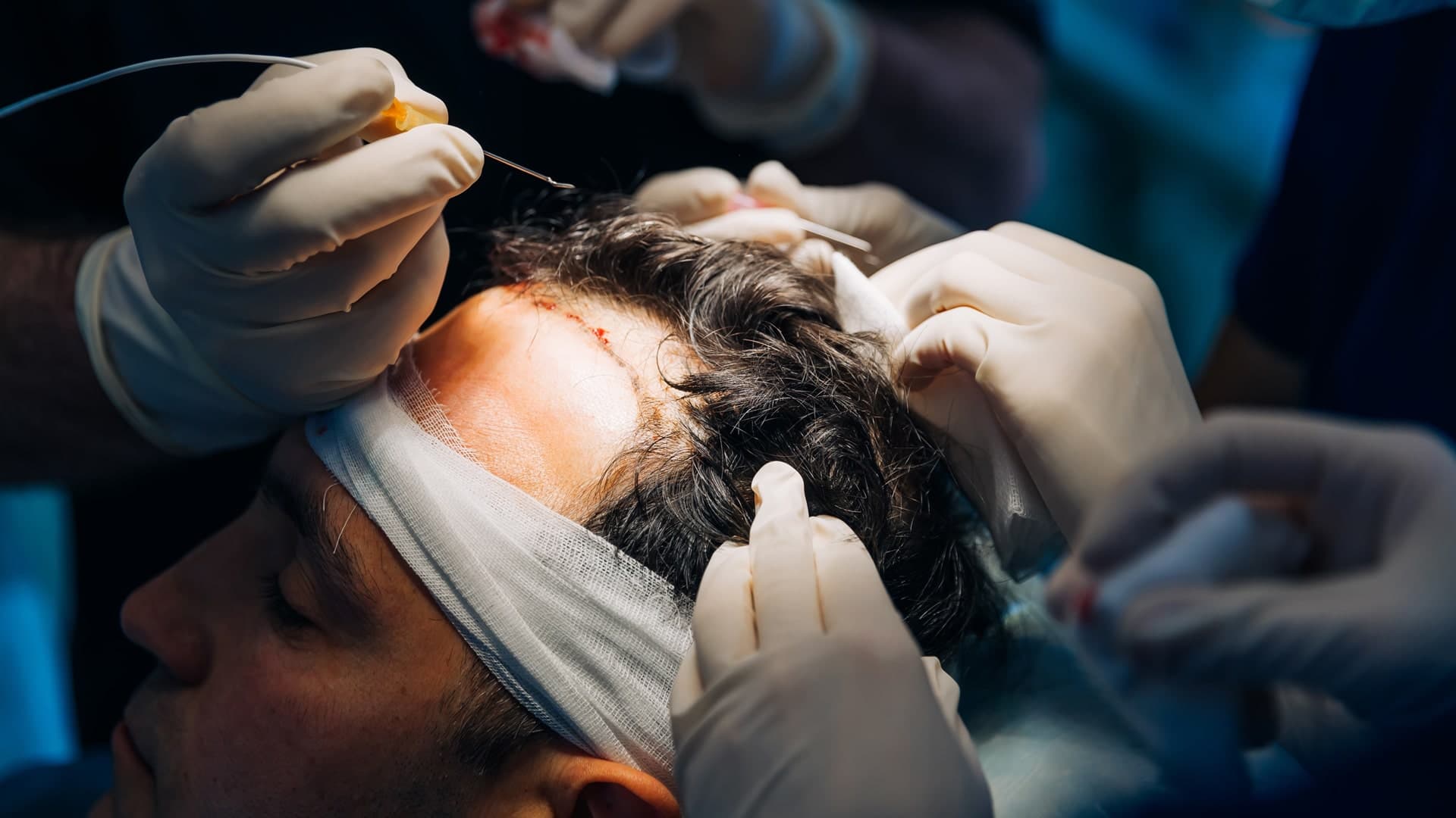 Surgeons perform a hair transplant on a man. Gloved hands, tools, and bandaged head are visible. The scene is focused and clinical, conveying precision.